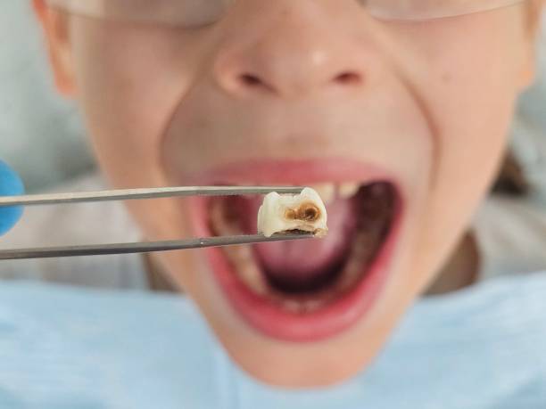 Best Emergency Tooth Extraction in Highland, NY
